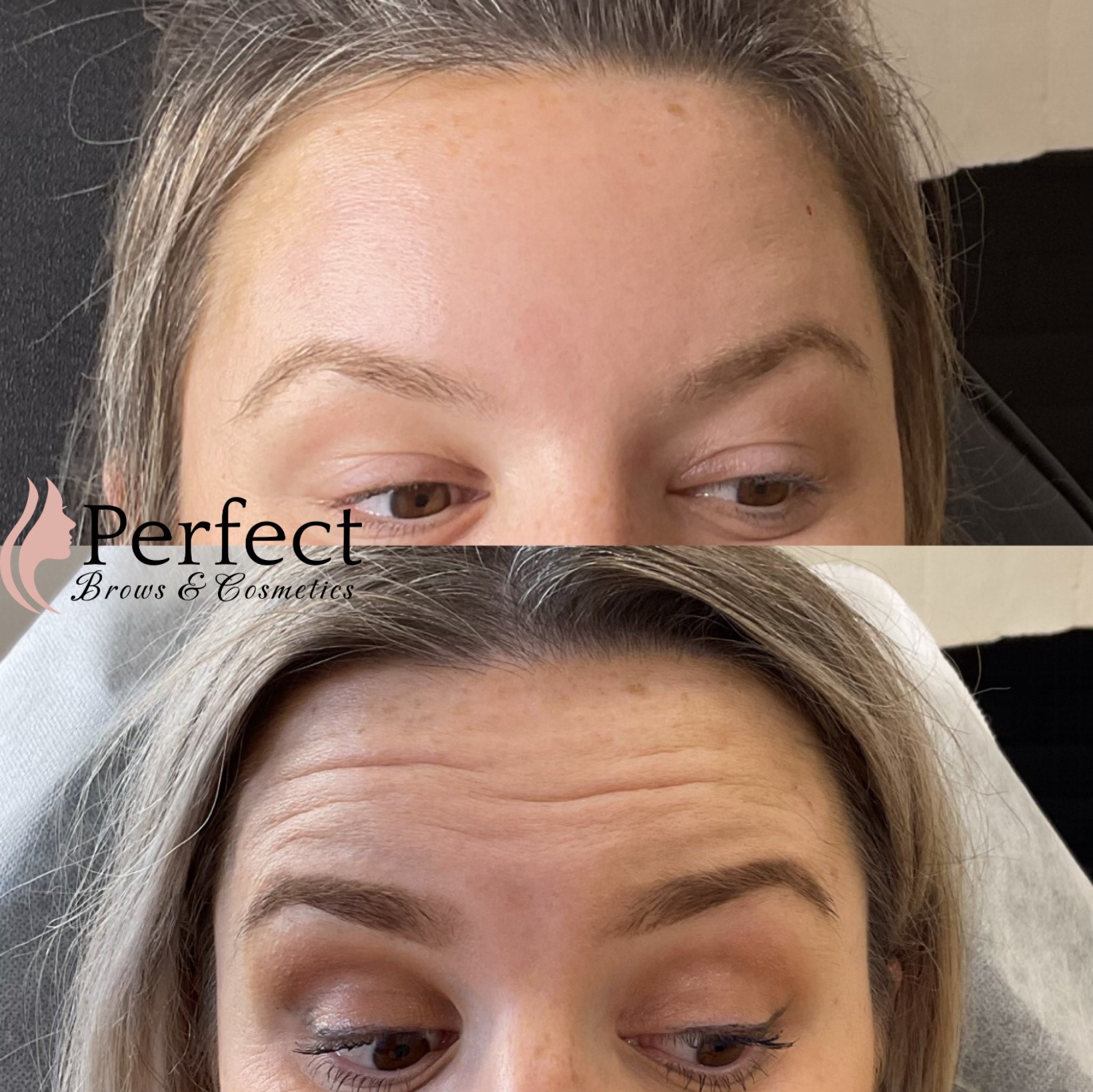anti wrinkle injectables adelaide